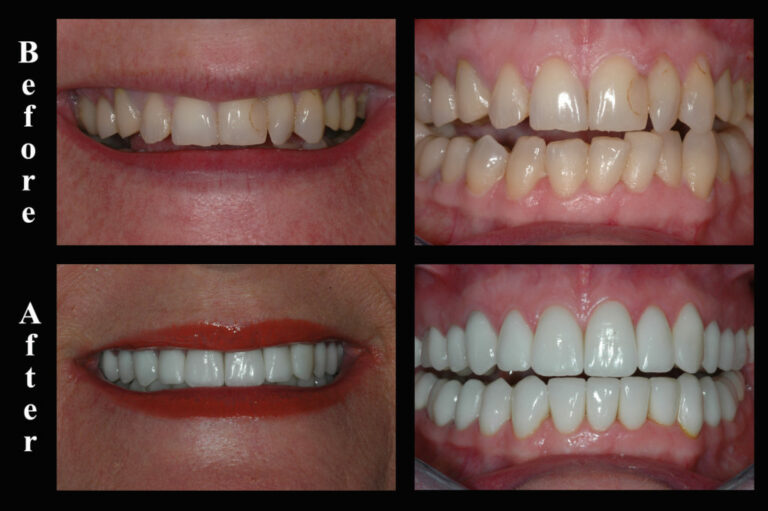 Porcelain Veneers Restore Those Yellow, Crowded, Uneven, Chipped