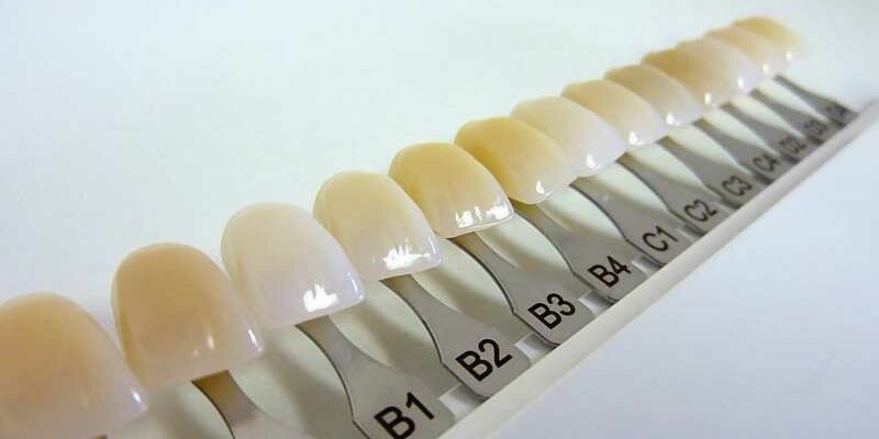 Dental Veneer Color Options - Steven T. Cutbirth Sedation Dentistry Waco Texas