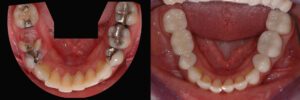 Amalgam Filling Replacement Before and After - Steven Cutbirth DDS Waco Texas