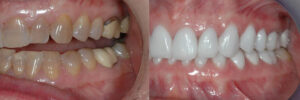 Restorative Dentistry Before and After - Steven Cutbirth DDS Waco Texas
