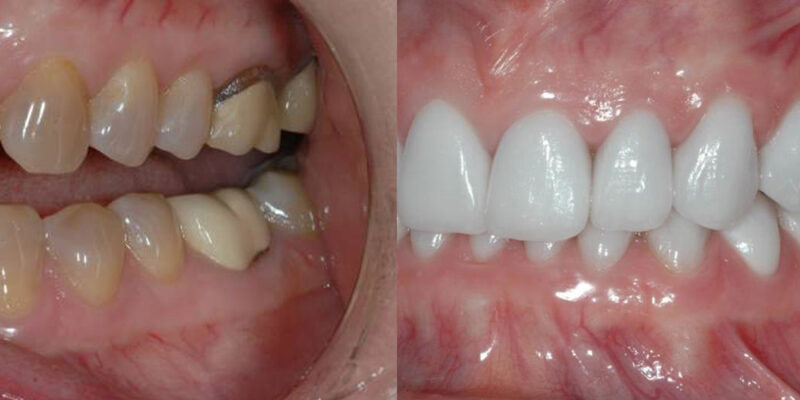 Restorative Dentistry Before and After - Steven Cutbirth DDS Waco Texas