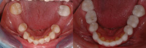 A gapped smile fixed with restorative dentistry techniques.