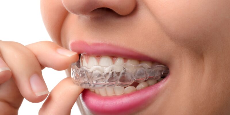 A woman inserting an Invisalign aligner.