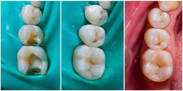 3 sets of teeth restored from start to finish at our general dentist office with our family dentist near you. We’ll stop your cavity from getting bigger and keep you out of pain with our white fillings from our dental clinic near you.