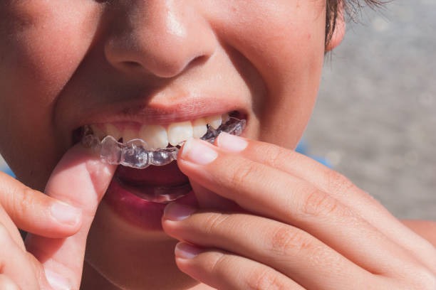 A person fitting invisalign braces on teeth in their Invisalign vs braces appointment.