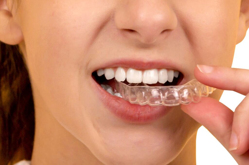 Woman placing a clear aligner on her teeth from an orthodontist near you with accelerated orthodontic treatment.