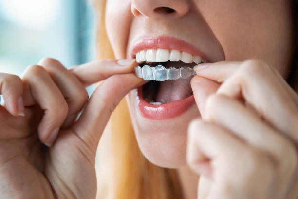 Close-up of a woman inserting her low-cost of Invisalign pricing onto her teeth.
