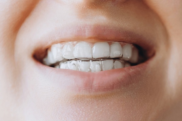 Close-up of a person wearing clear Invisalign aligners on their teeth.