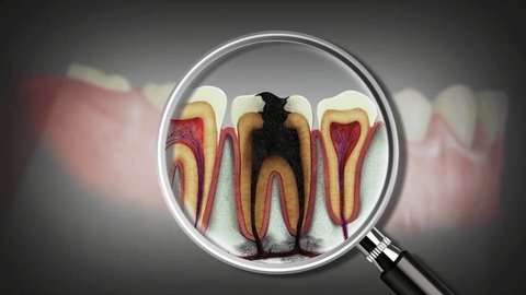 Infected tooth getting a root canal near you by an endodontic expert with a low root canal cost.