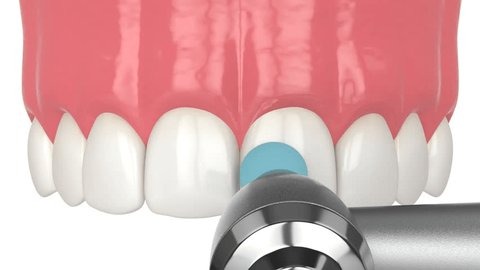 Polishing up somedental bonding on a front tooth using composite bonding resin for a cavity.