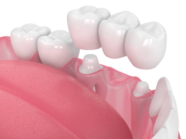 Close-up of porcelain crown teeth and a bridge restoration ready for placement to crown your teeth.