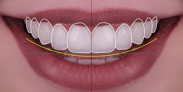 The dental cosmetic image shows Digital Smile Design enhancing smile shape with precise guides with our cosmetic dentist near you.