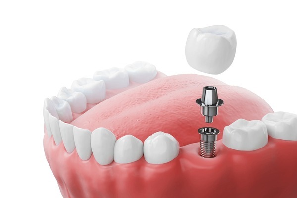 A 3D model showing how dental implants near you replace missing tooth roots with implant dental treatment.