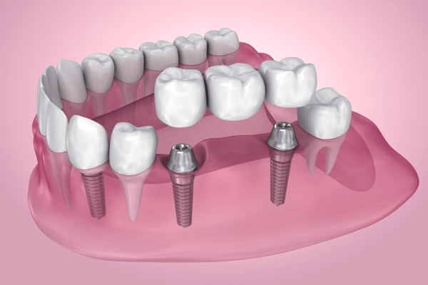 Implant bridge dental work supported by two titanium implants in the lower jaw.