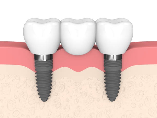 A fixed implant tooth bridge (dental) supported by two titanium implants in the jawbone.