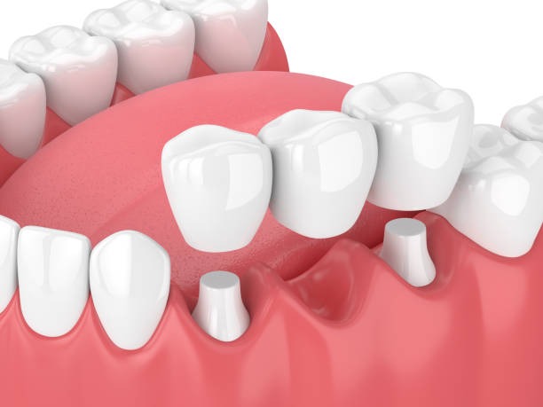 A tooth bridge (dental) is placed over prepared teeth to replace a missing tooth.