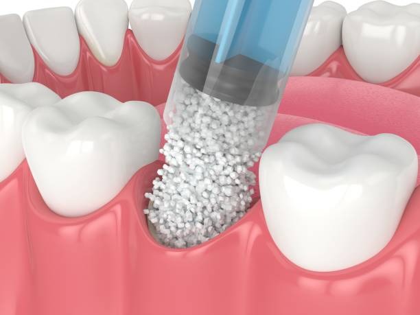Dental bone graft to help support your implants.