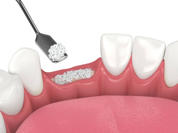 This is a bone graft dental procedure to support your implants. The bone graft tooth is placed on top of the dental bone grafting material.