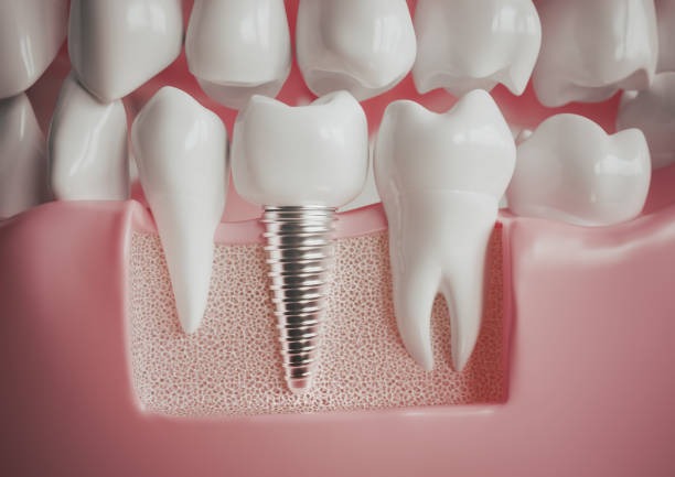 A doctor showing treatment options and explaining your dental implant cost clearly. We offer a very competitive price for dental implants.