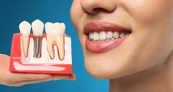 A dental office helping patients understand the price for dental implants.