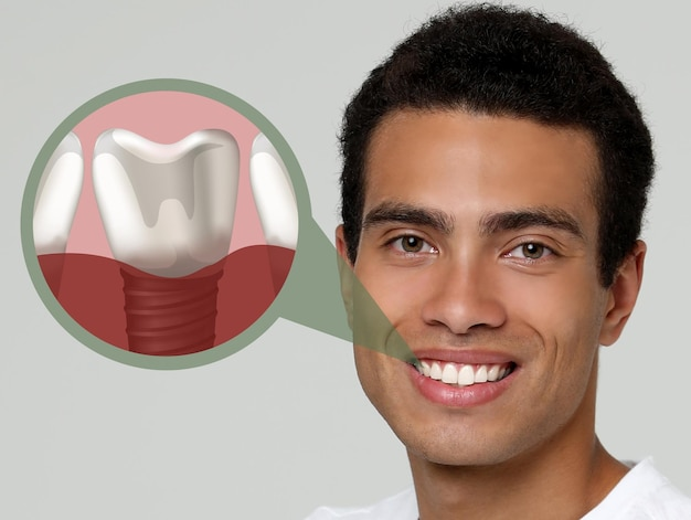 Smiling man with an implant tooth illustration showing single tooth implant replacement at a dentist for implants near you.