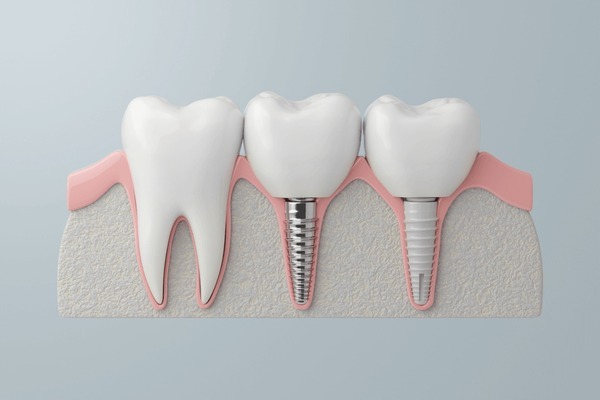 Illustration showing one natural tooth and two dental implants, highlighting the benefits of implant dental treatment for a natural, long-lasting smile with our implant dentist near you.