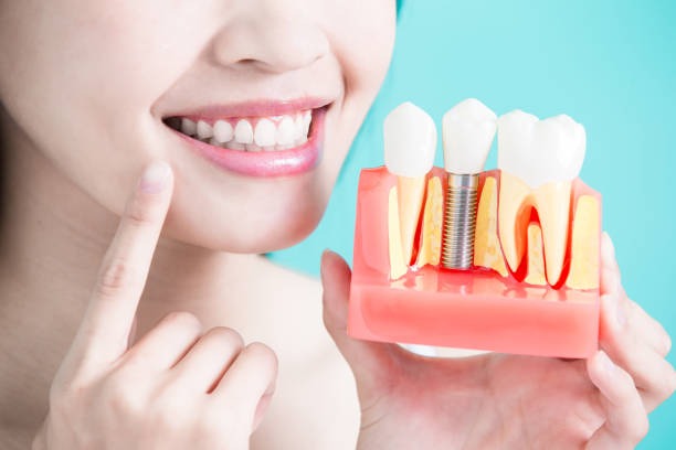 An implant dentistry patient smiling and pointing to their dental implant with a model, showcasing how dental implants work.