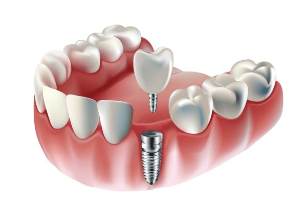 Dental implant procedure showing a missing tooth replaced, showing how implant dentistry and dental implants work.