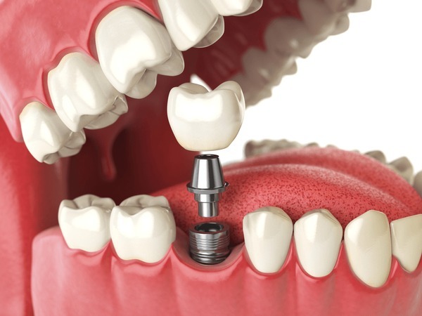 Dental implant procedure showing how dental implants work in replacing a missing tooth with implant dentistry.