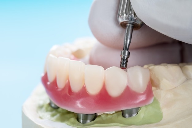 Close-up demonstration of a dental implant being placed into a model jaw, showing how implant posts support a full-arch restoration.
