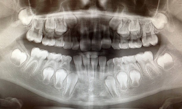 Visual of a metal-free dental implant placed in the jawbone, highlighting its natural-looking ceramic structure for improved aesthetics.