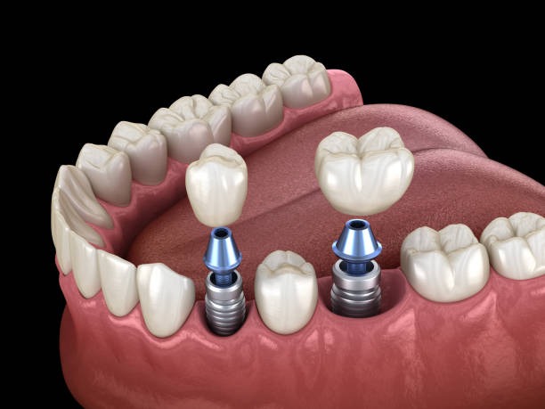 Close-up of dental implants being placed, showcasing the strong and secure foundation for tooth replacement.