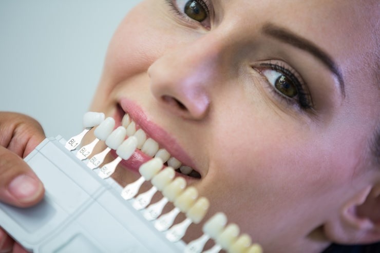 Set of dental veneers showing different tooth shades at a porcelain veneers cost consultation.