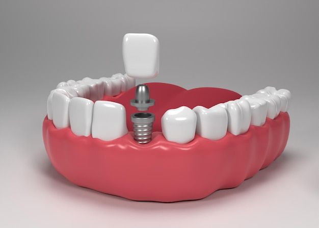 3D illustration of a dental implant post, abutment, and crown demonstrating how a single-tooth dental implant is placed.
